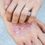 Plaques - Flat and raised skin changes in plaque psoriasis