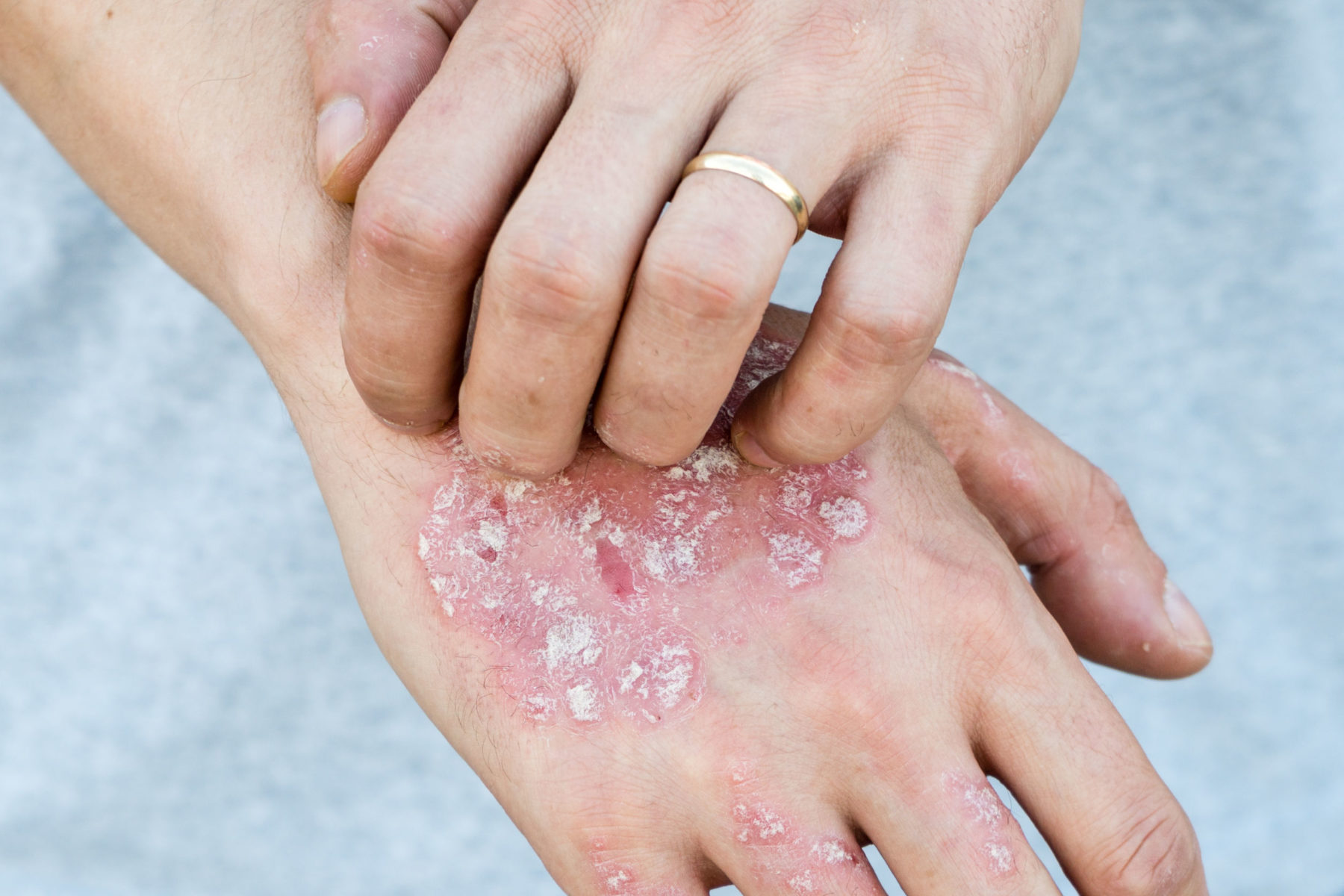 Plaque Psoriasis On Hands