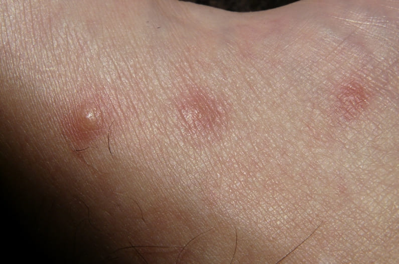 Psoriasis pustulosa – a special form of psoriasis with pustule